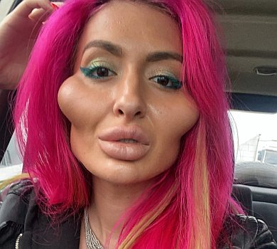 Киянка з найбільшими у світі вилицями розказала, скільки витратила на пластичні операції