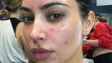 Не дайте псоріазу зруйнувати ваше життя: Кардашян показала чесні ФОТО 