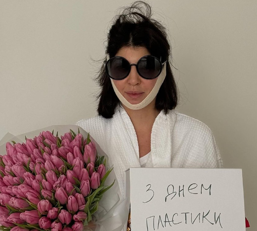 Люблю свій зламаний ніс і худі ноги: Муcіна здивувала обличчям після пластичної операції