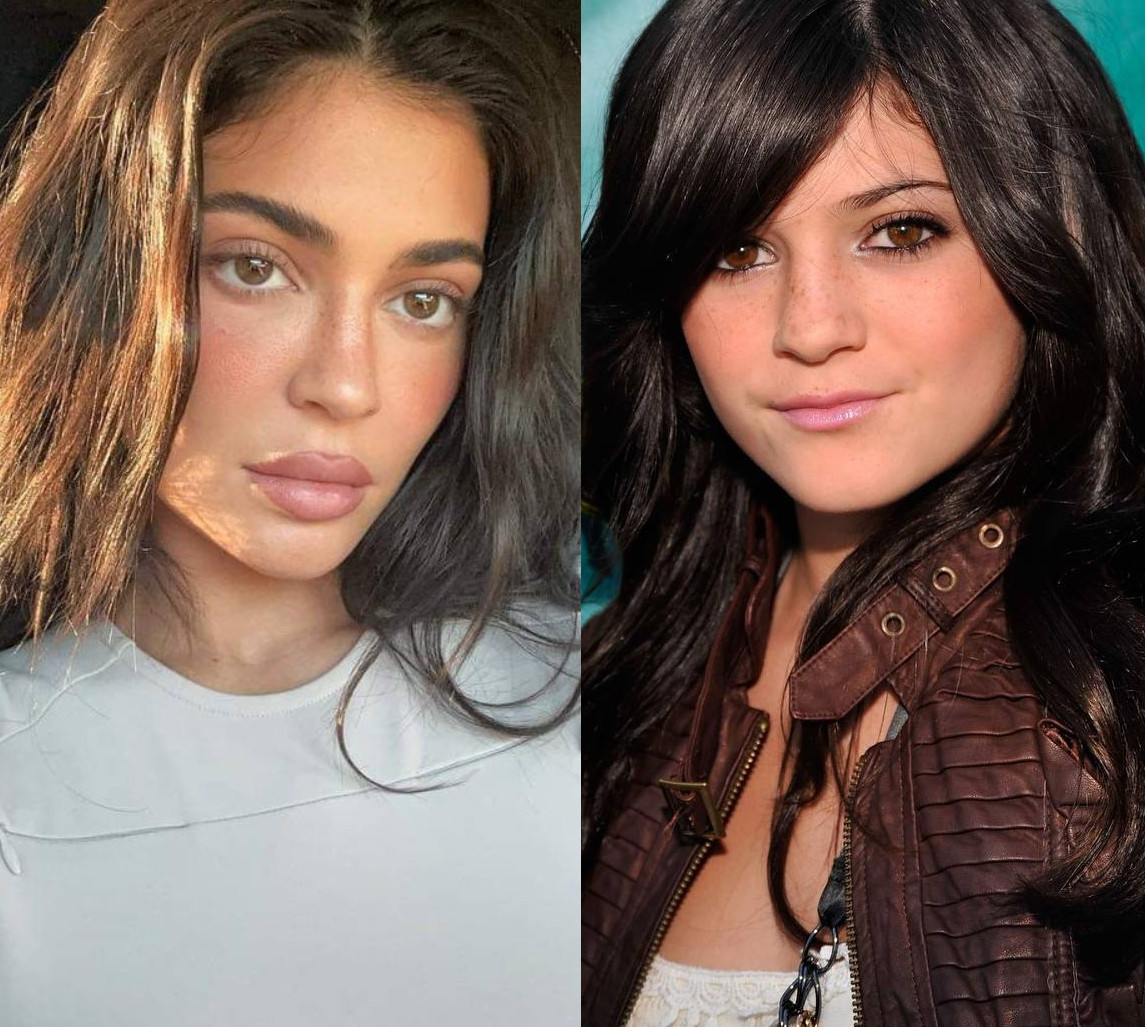 Кайлі Дженнер, Шерон Озборн, сімейка Сталлоне та Нікі Мінаж: пластичні операції зірок, які видно неозброєним оком. Фото