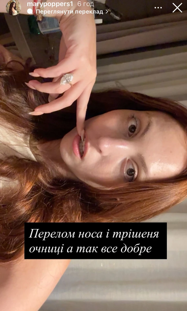Окрім перелому носу, у Маші тріщина очниці