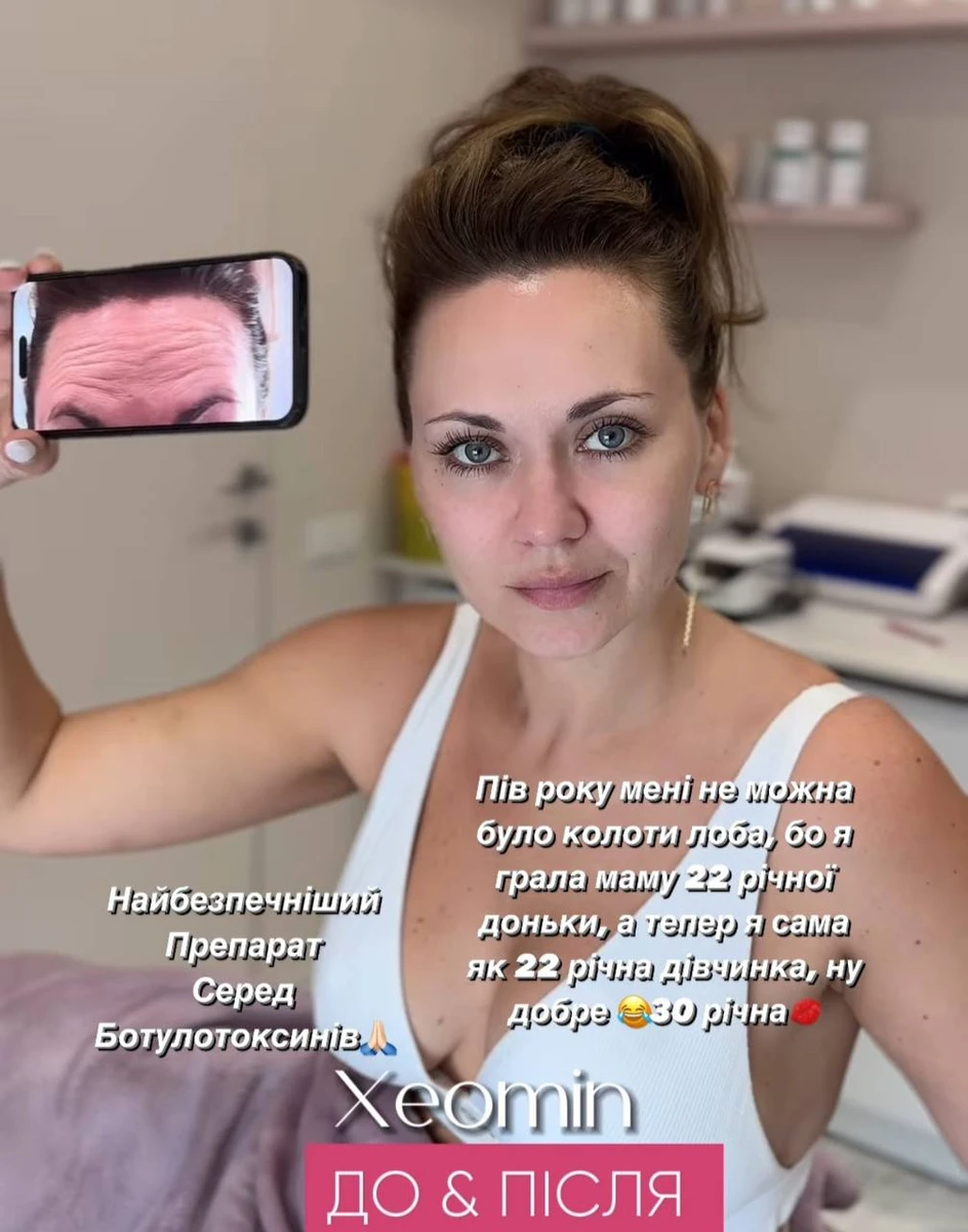 Анна показала результат ботулінотерапії