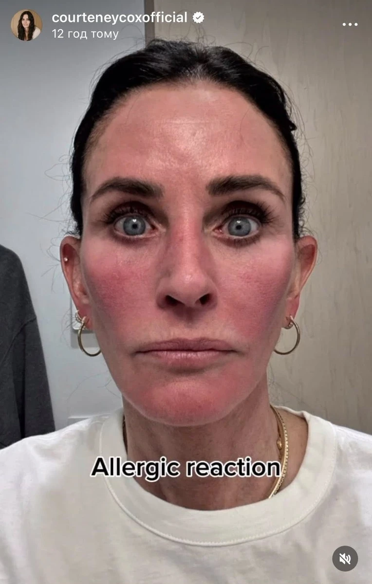 Алергічна реакція на обличчі