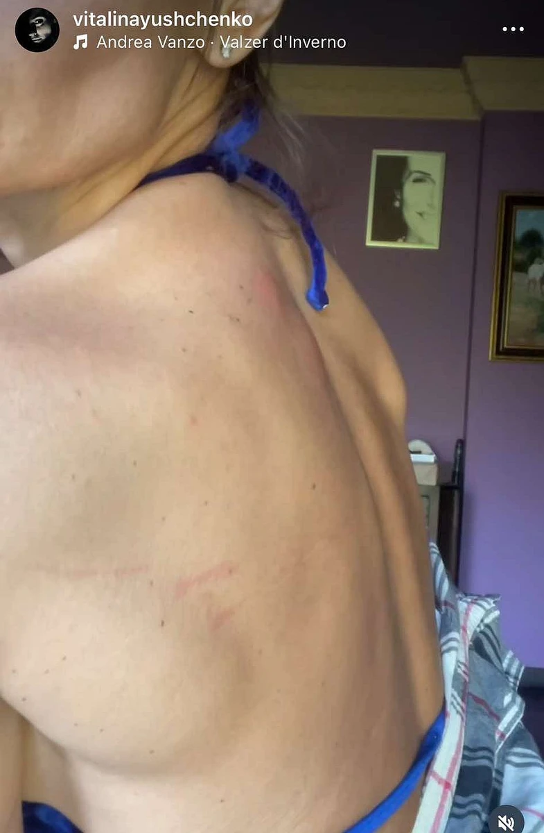 У Віталіни оніміло плече