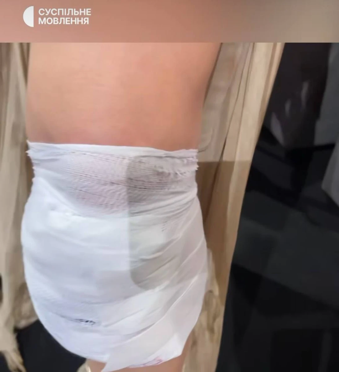 Так нині виглядає коліно співачки