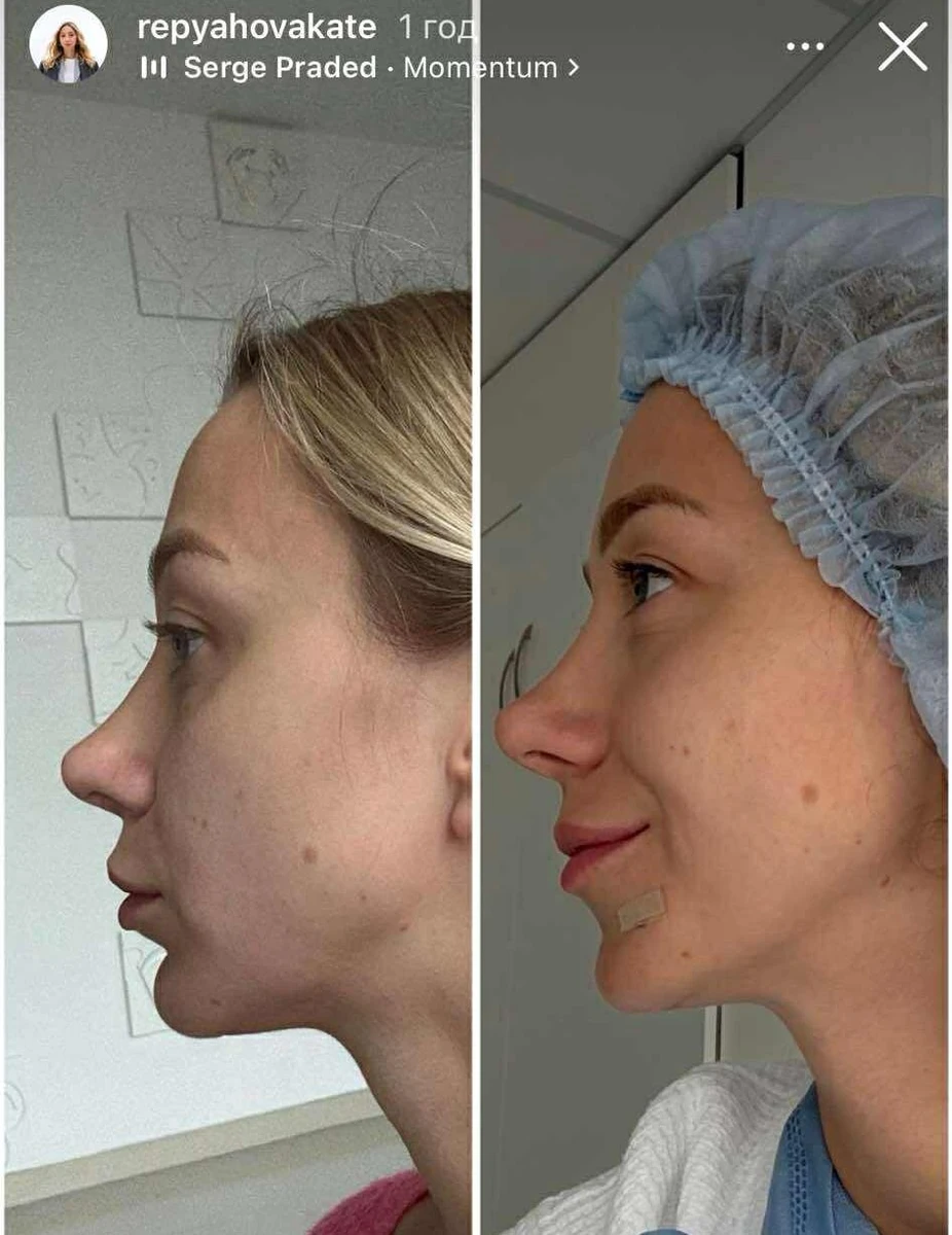 Репяхова показалася до та після пластики