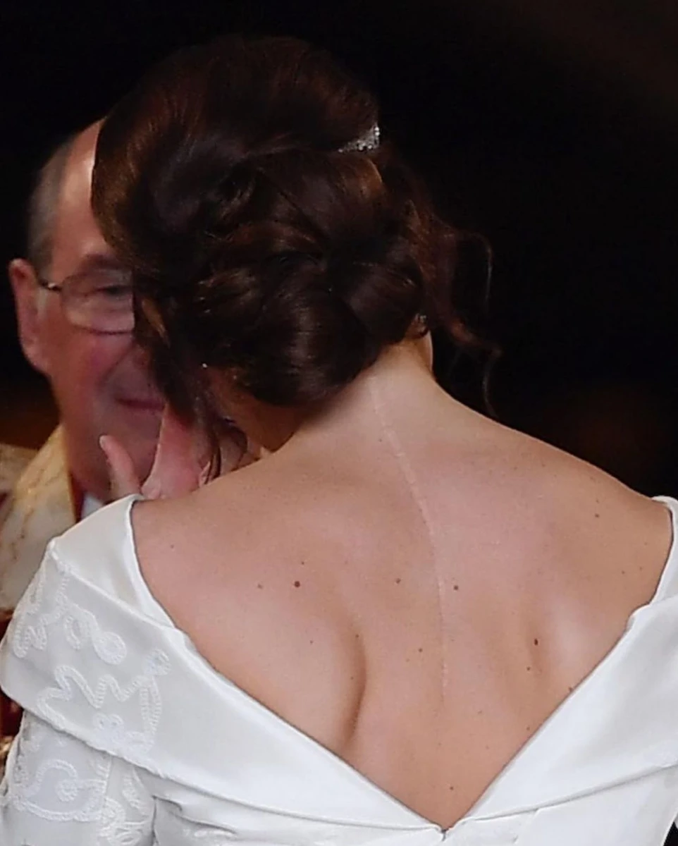 Принцеса Євгенія показала свій шрам від сколіозу