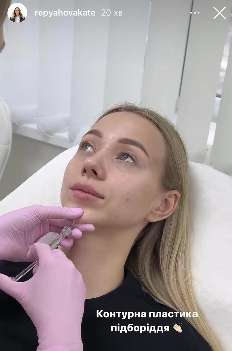 Репяхова коле філери у підборіддя