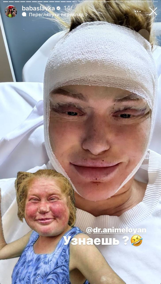 А ось це обличчя Слави після операції