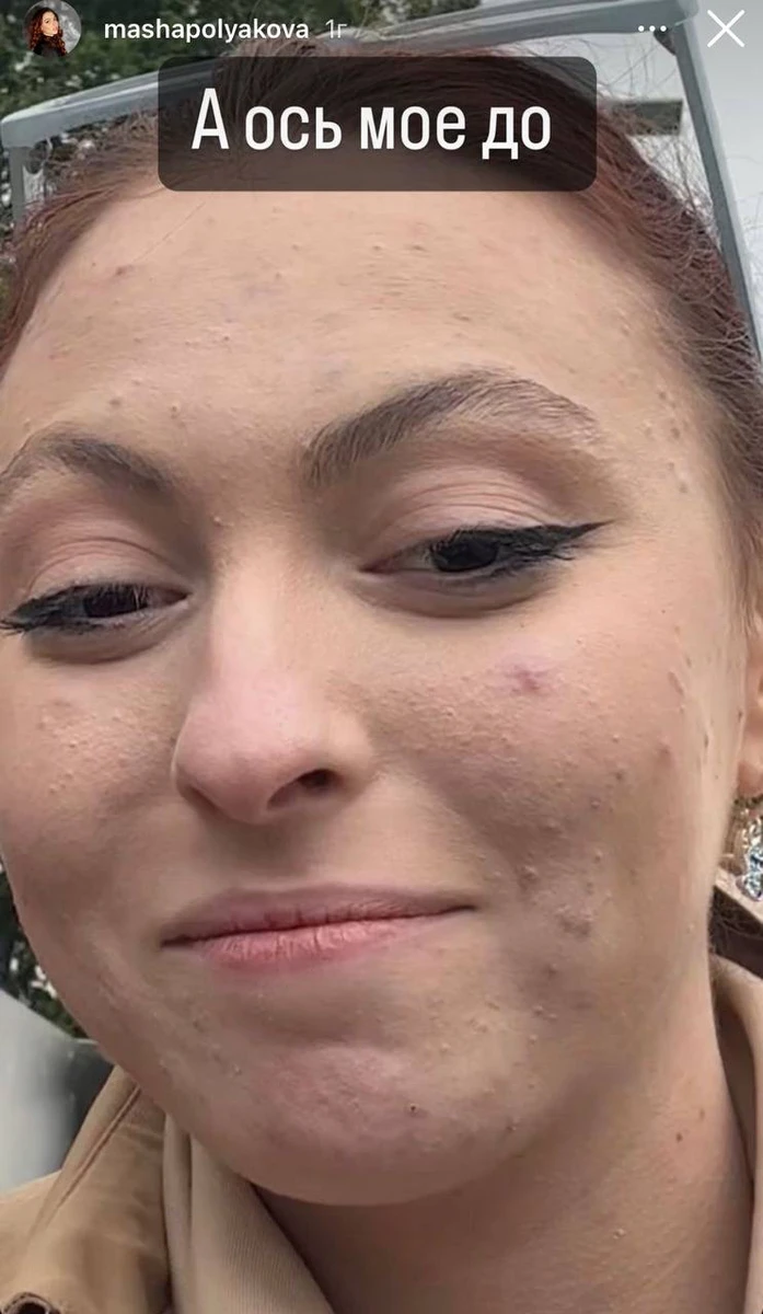 Дівчина показала, як виглядала шкіра до лікування