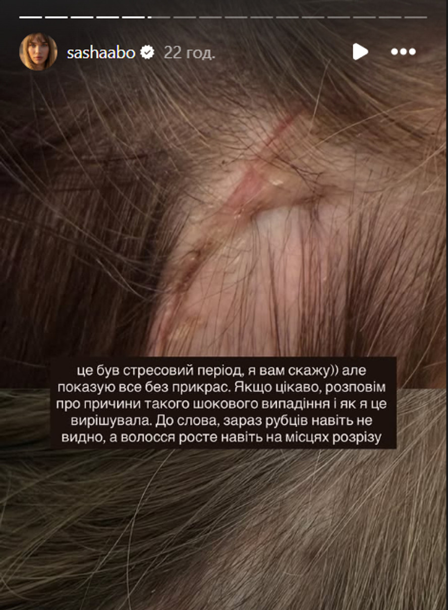 Саша Бо розповіла про випадіння волосся