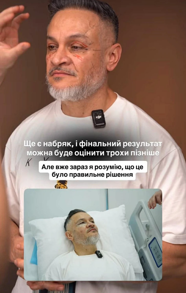 Набряк після операції ще не зійшов, але Ектор вже задоволений 