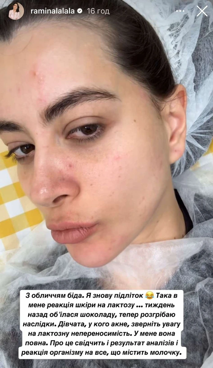 Раміна показала акне