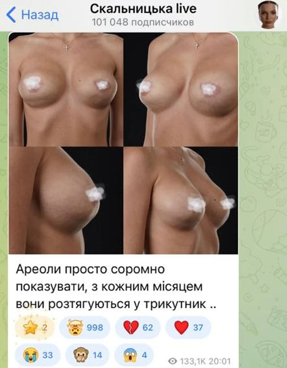 Першу операцію блогерка зробила після народження доньки Мілани в 2022-му, другу - після народження сина Михайла в 2024-му