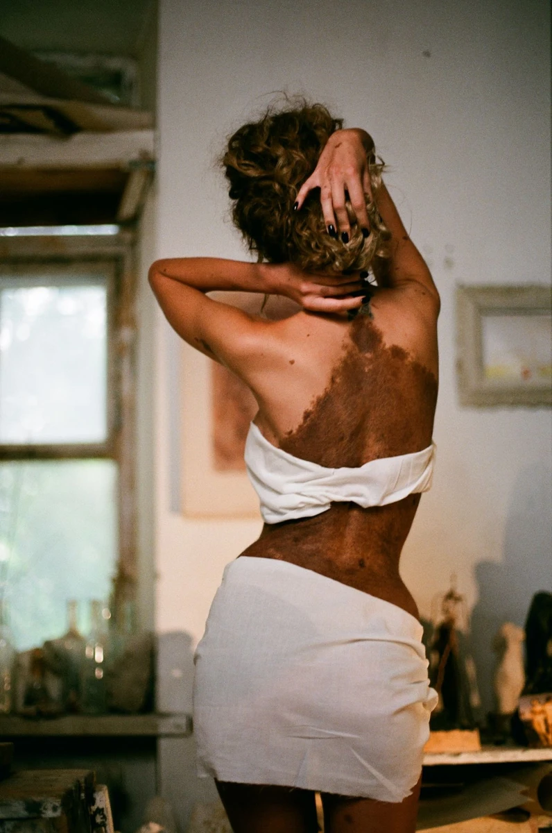 Велика пляма на спині Юліанни вкрита волоссям і часто доставляє їй дискомфорт