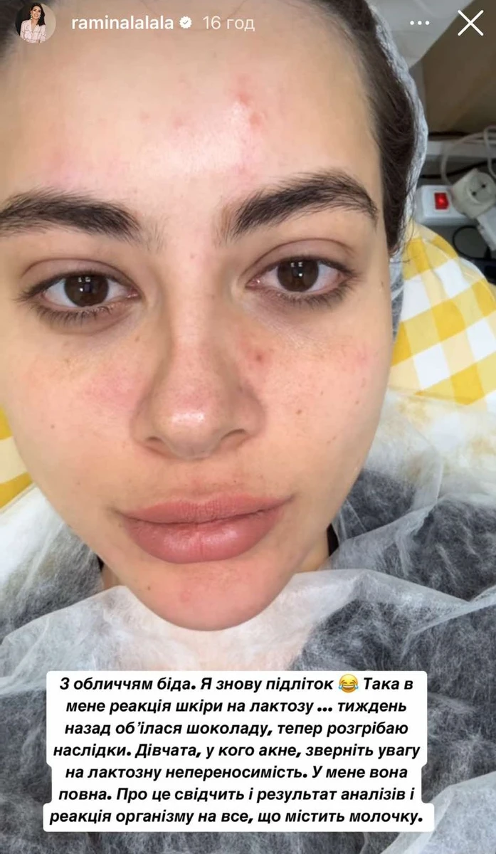 Раміна показала прищі на обличчі