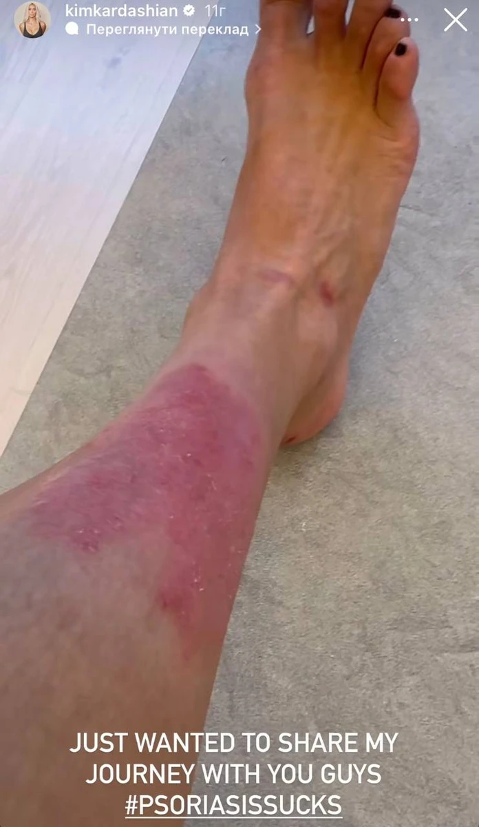 Про цю хворобу теледіва вже розповідала раніше