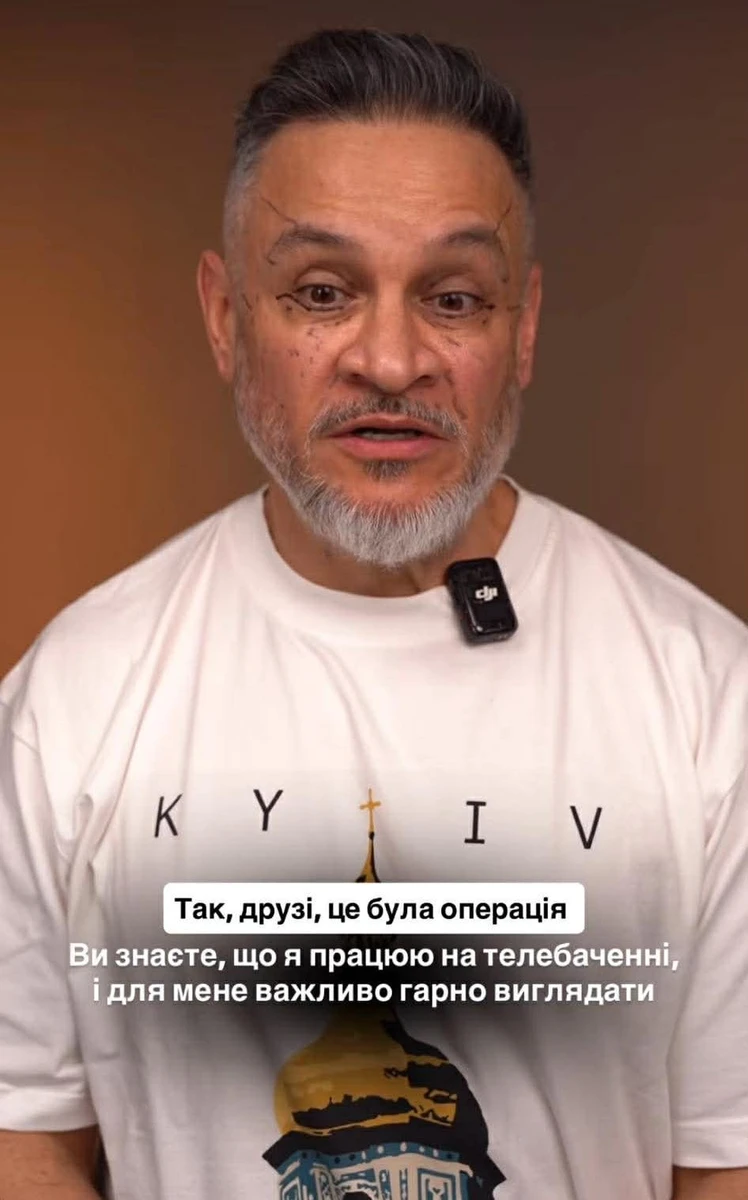 Ектор про пластику на обличчі