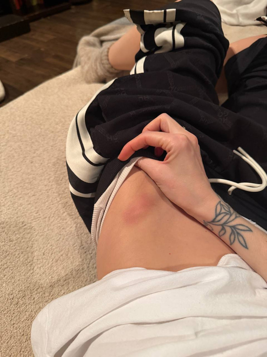 Надя Дорофєєва показала наслідки своїх активних репетицій