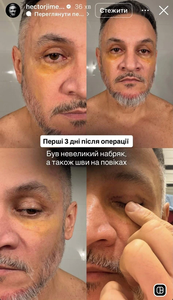 Ектор Хіменес-Браво і його блефаропластика