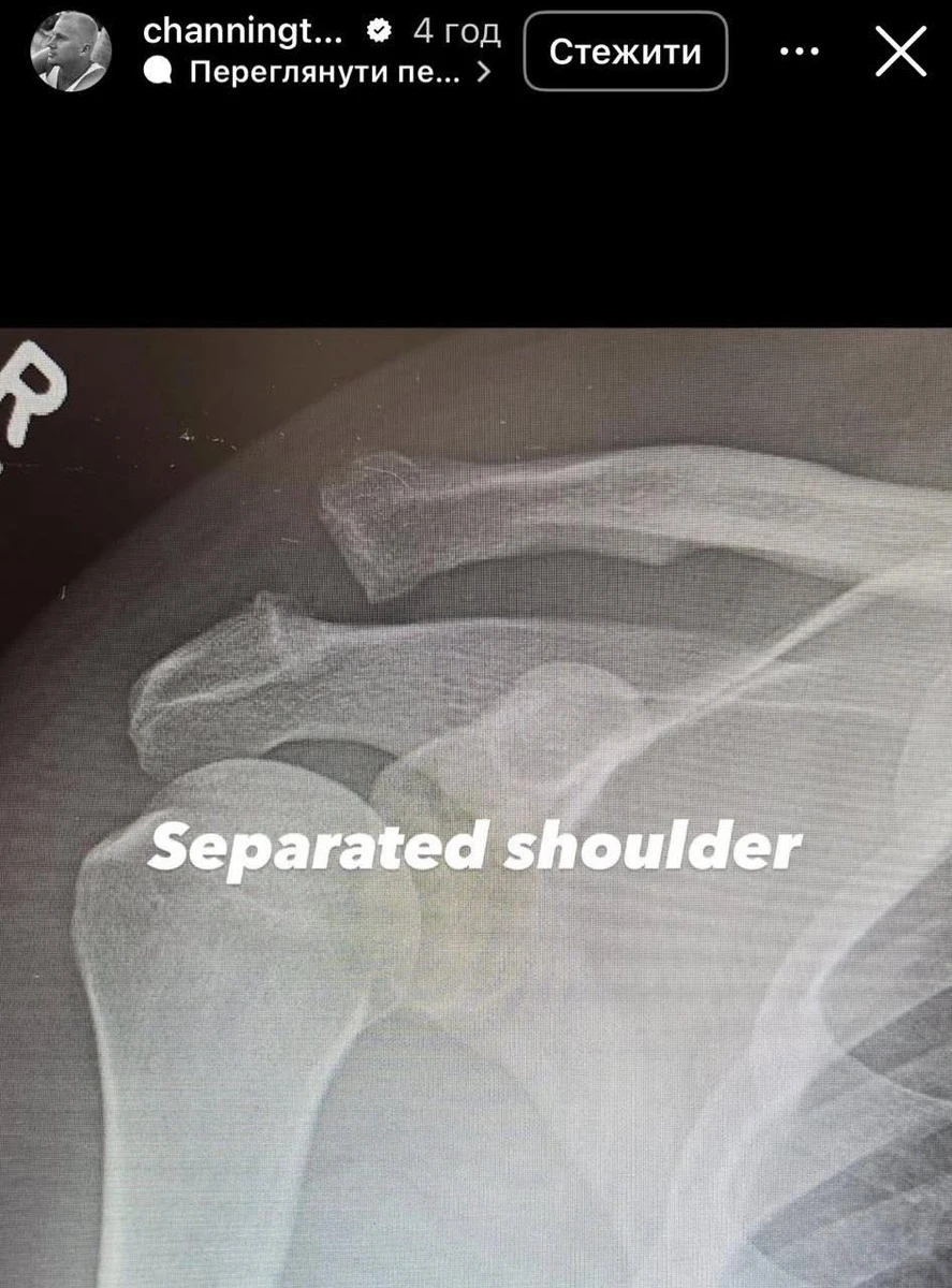 Вивих (роз'єднання) акроміально-ключичного суглоба