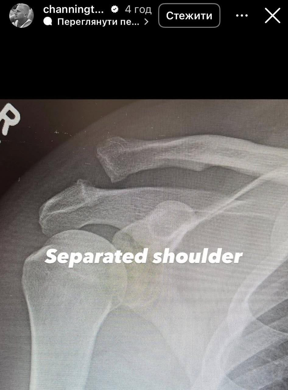 Вивих (роз'єднання) акроміально-ключичного суглоба