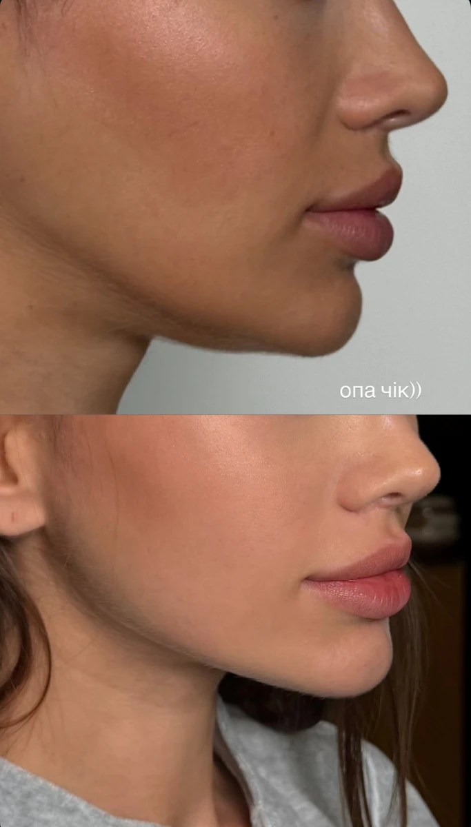 Саша Бо показала зміни у своєму обличчі після підтяжки