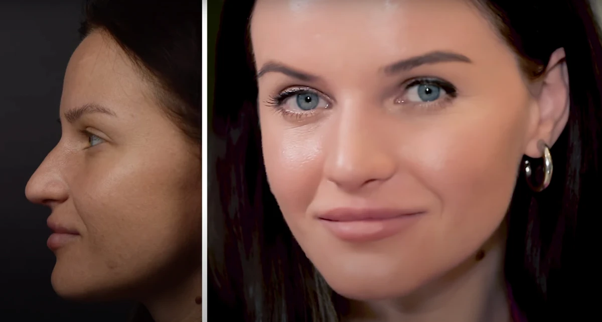 Алтіна Доротюк до та після операції на носі