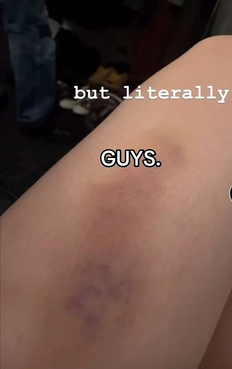 Синець на нозі Біллі Айліш після падіння