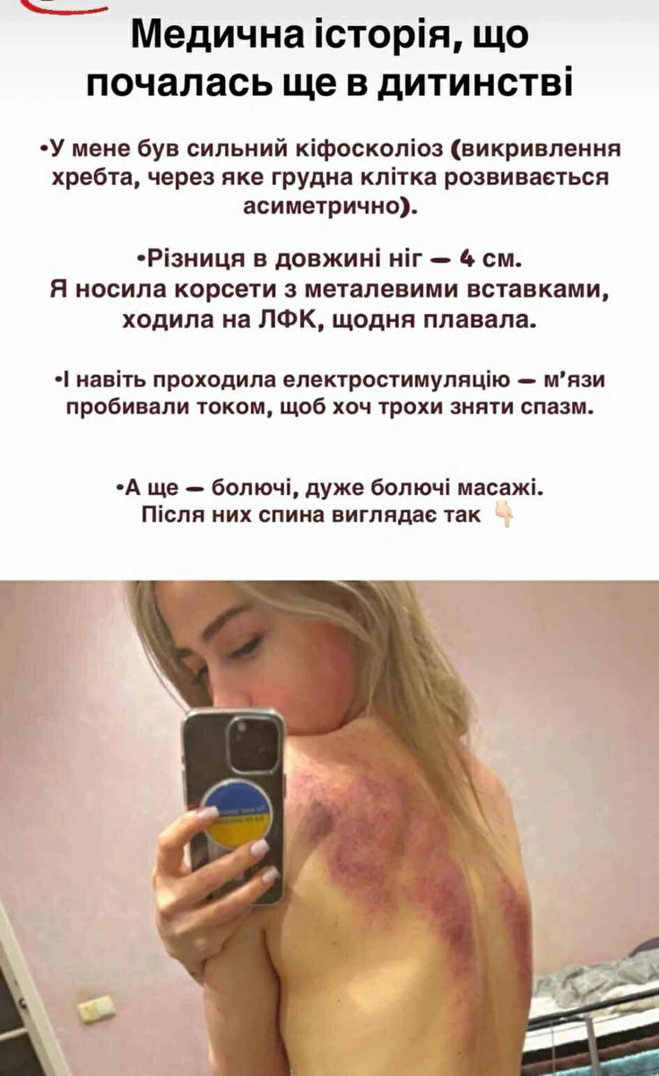 Бєлєнь з Холостяка-13 показала синці на спині після процедур