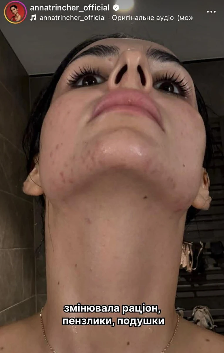 Що тільки не робила співачка, щоб позбутися прищів 