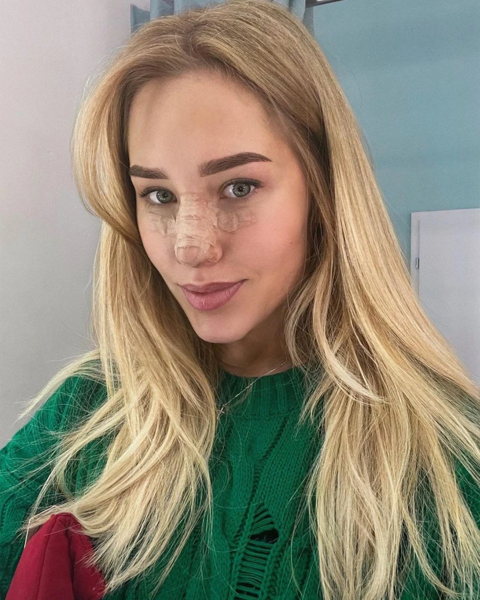Даша Квіткова після ринопластики
