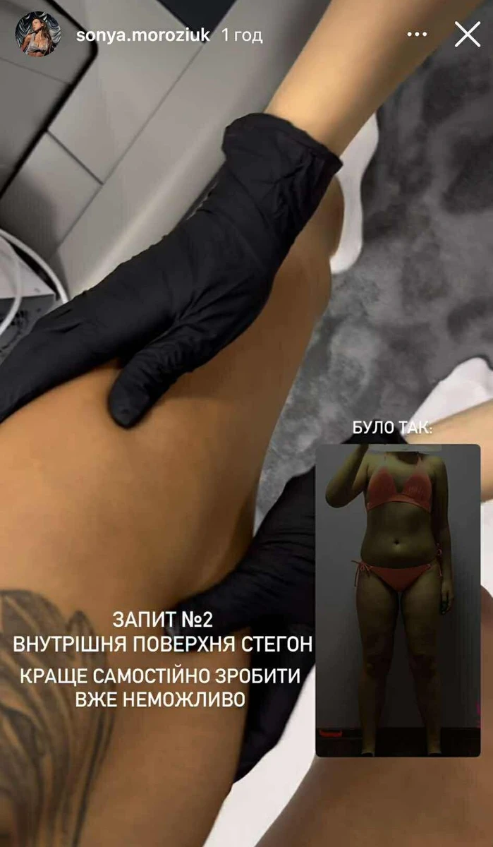 Шкіра на внутрішній стороні стегна Соні втратила тонус 