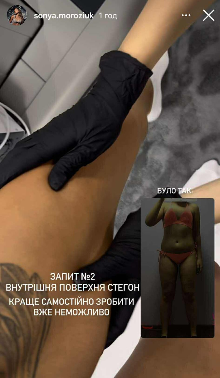 Шкіра на внутрішній стороні стегна Соні втратила тонус 