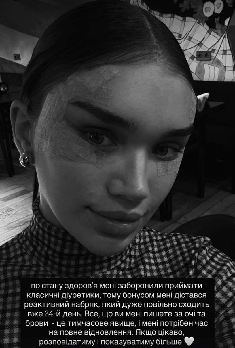 Саша Бо показала набряк обличчя після того, як зробила підтяжку