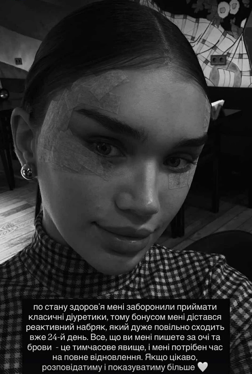 Саша Бо показала набряк обличчя після того, як зробила підтяжку