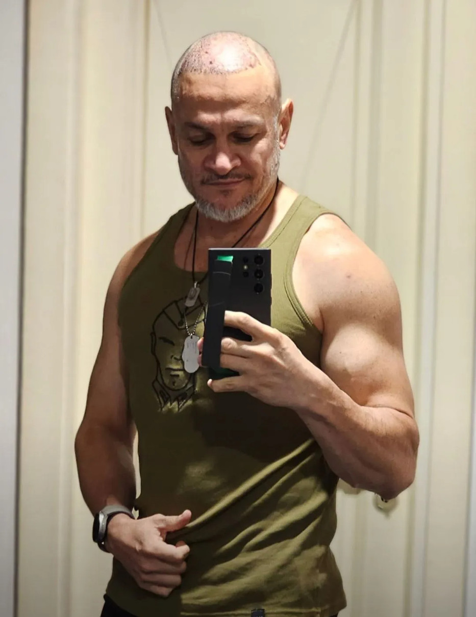 Ектор Хіменес-Браво після пересадки волосся