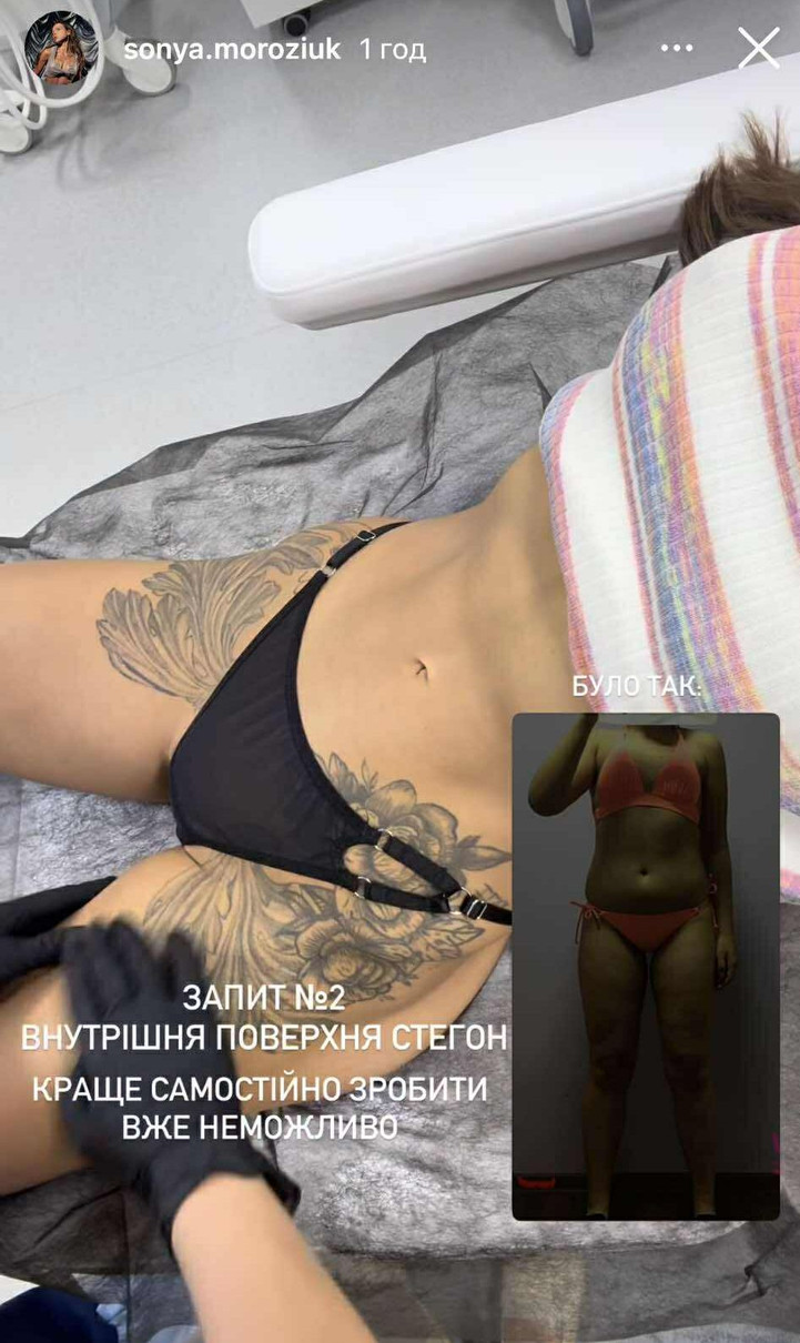 В цю частину Соні робитимуть ін'єкції ліполітиків 