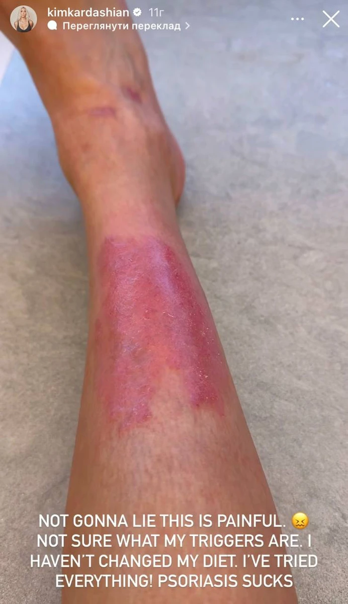 Кім показала уражену псоріазом ногу