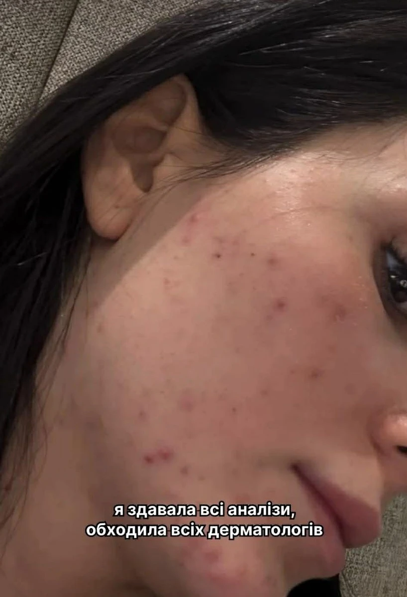 Акне розповсюджена проблема, і багато зірок розповідали про свій шлях боротьби з нею 