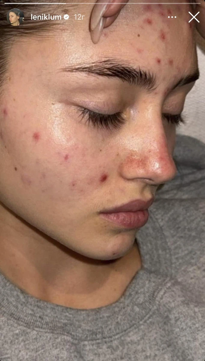 Інколи шкіра юної красуні-моделі Лені виглядає ось так