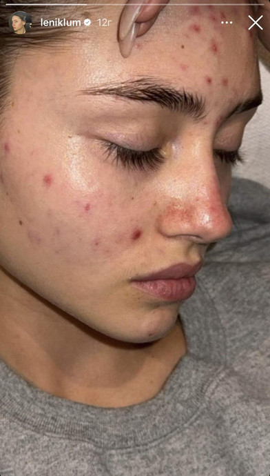 Інколи шкіра юної красуні-моделі Лені виглядає ось так