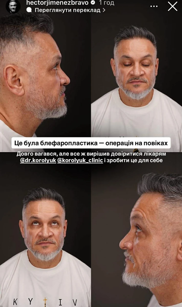 Ектор Хіменес-Браво розповів про блефаропластику