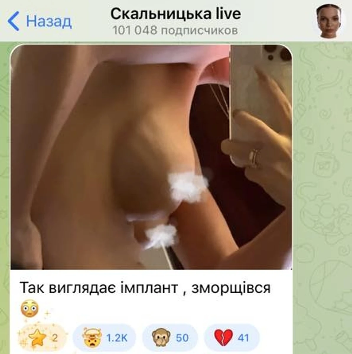 Анастасія Скальницька і її мамопластика