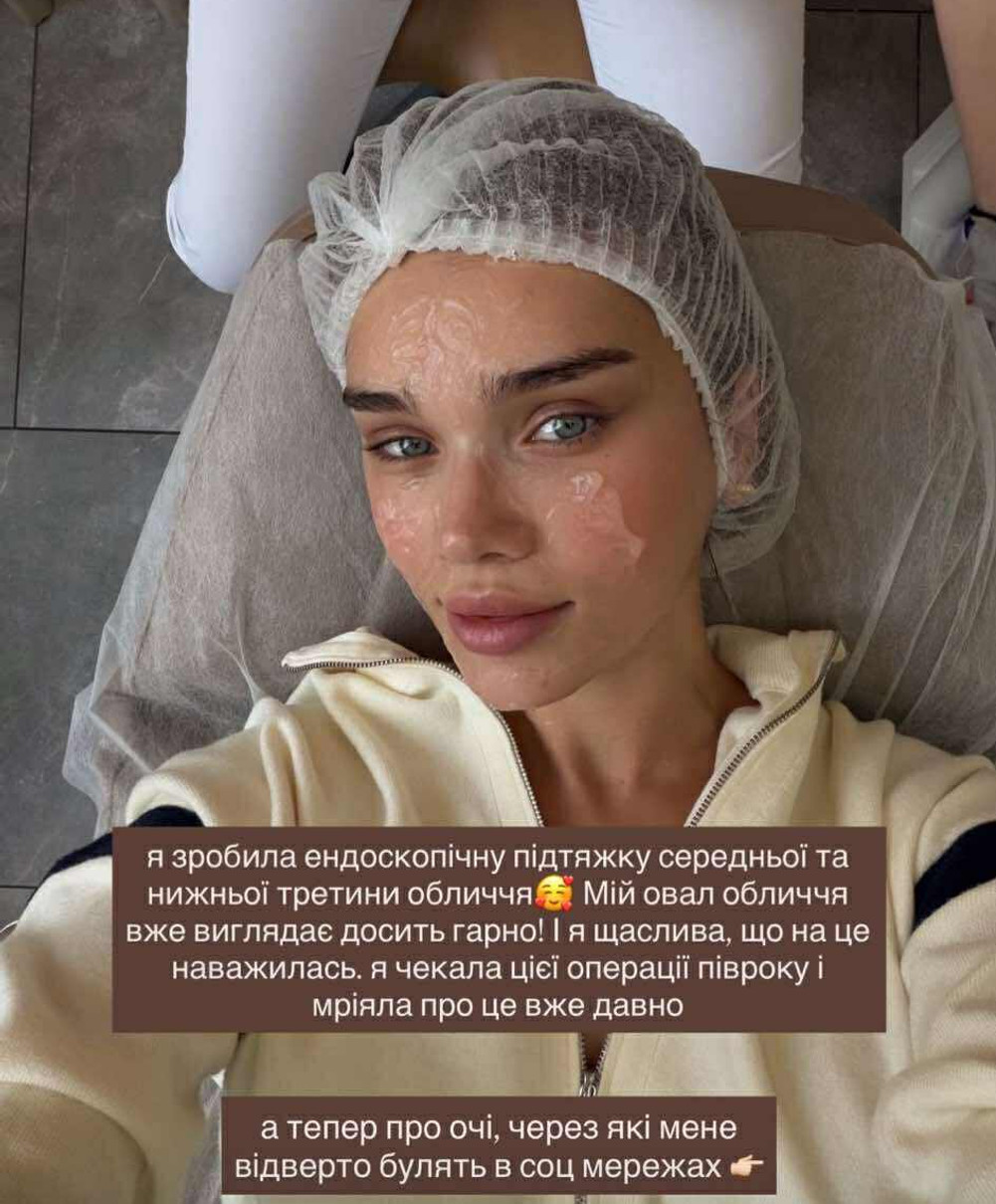 Саша Бо зробила підтяжку обличчя, щоб змінити овал