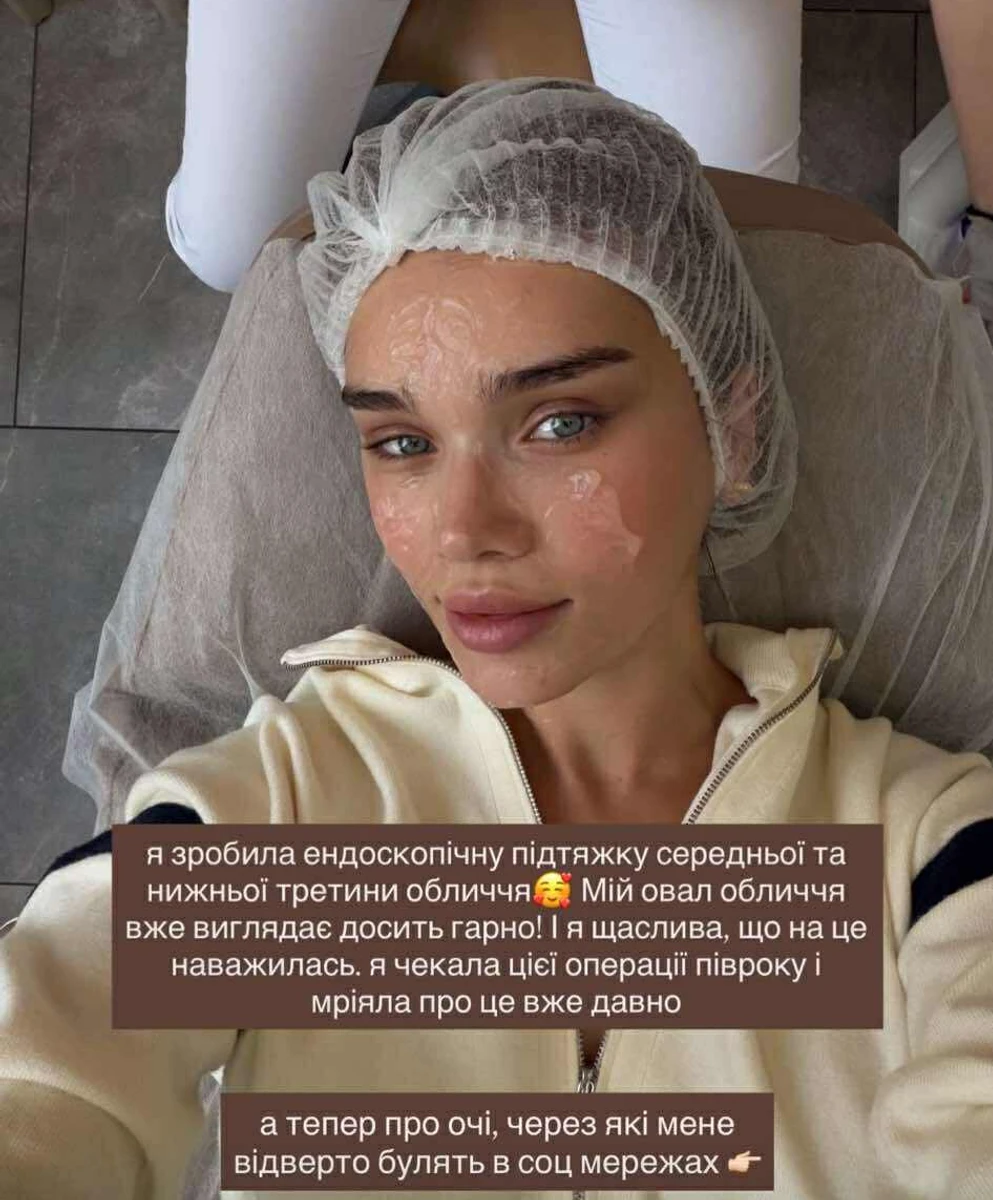 Саша Бо зробила підтяжку обличчя, щоб змінити овал