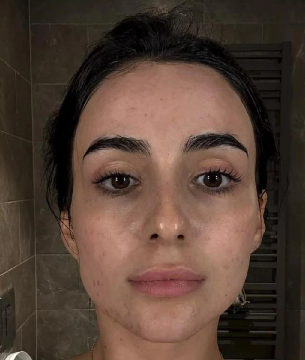 Трінчер показала лице з акне