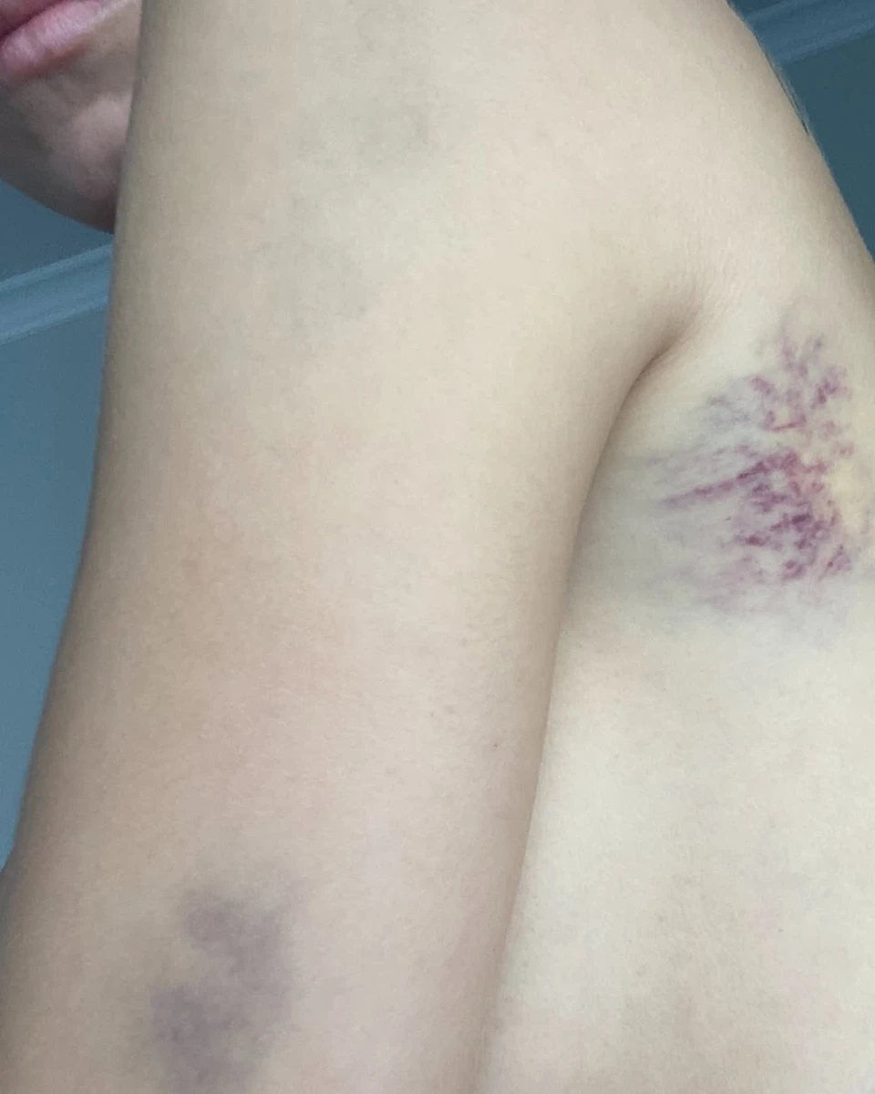 Сліди побиття на тілі