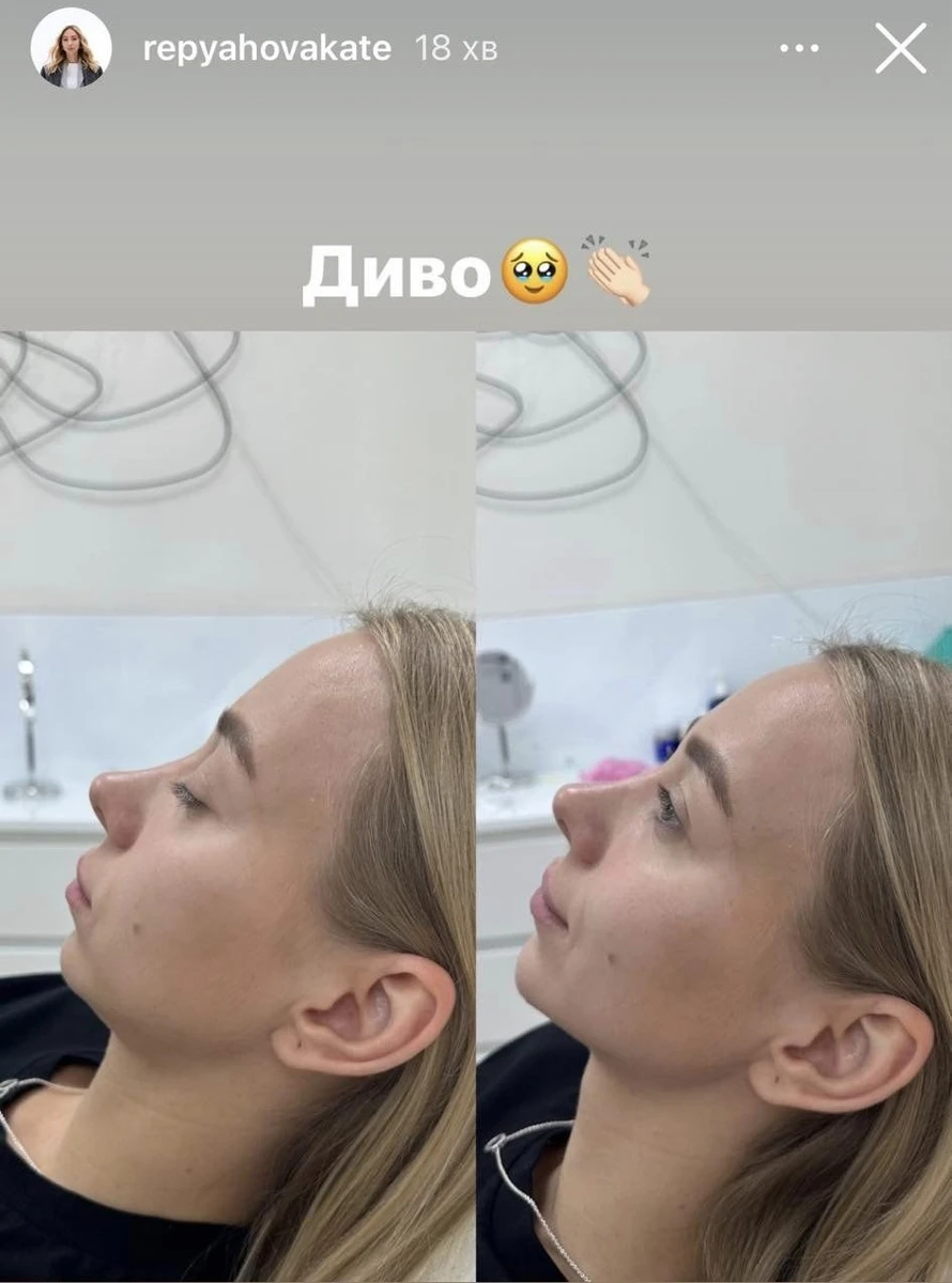 Катерина Репяхова до і після уколів