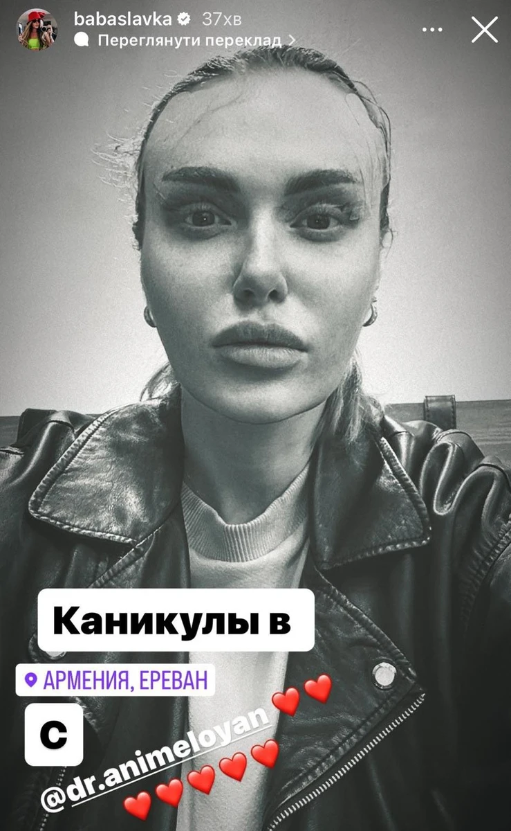 І нарешті вона показала обличчя, на якому ледь помітні пластирі на скронях та повіках 